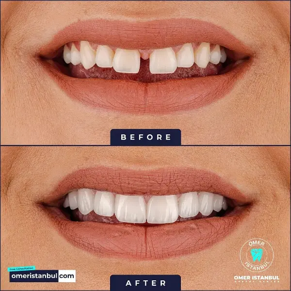 dental-hollywood-smile-16-1 (1)