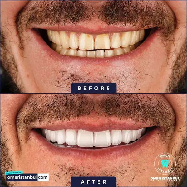 emax-veneer-before-after