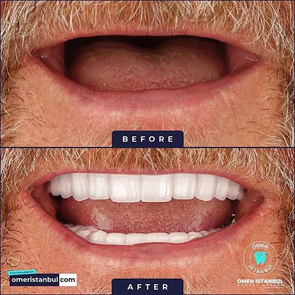 implant-treatment-4-1-1