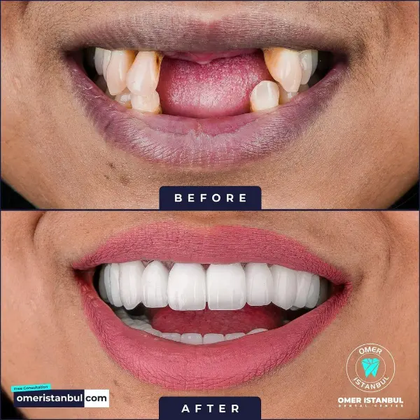 zirconium-crown-before-and-after-5 (1)