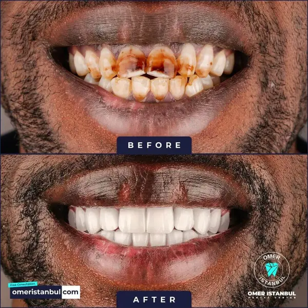 zirconium-crown-teeth-8